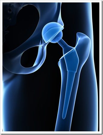 Back Pain Los Angeles CA Joint Replacement