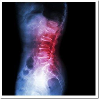 Back Pain Sunnyvale CA Arthritis