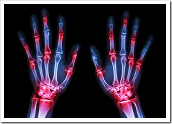 Rheumatoid Arthritis Solutions Mauldin SC