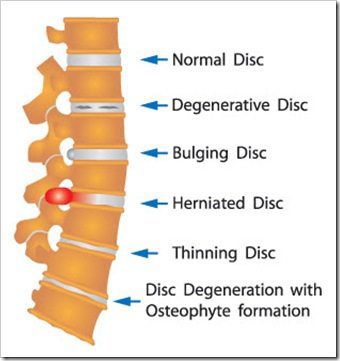 Back Pain Broomall PA Arthritis