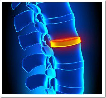 Herniated Disc and Back Pain OFallon IL