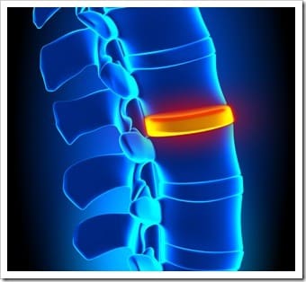 Herniated Disc and Back Pain Pottstown PA