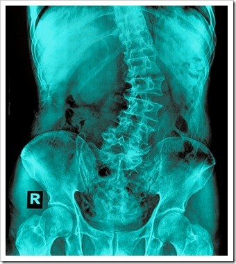 Scoliosis Jackson MS Pain Relief