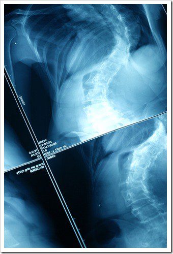 Broomall Scoliosis