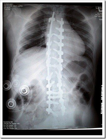 New Fairfield Scoliosis