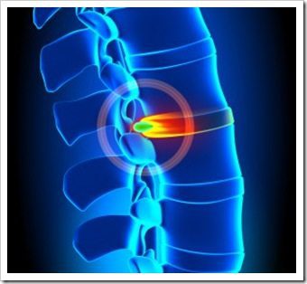 Back Pain Berwyn PA Spinal Decompression