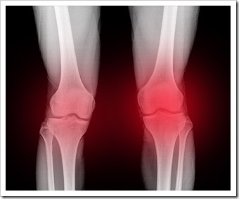 Osteoarthritis Berwyn PA Knee Pain