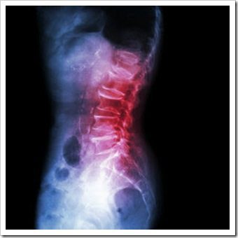 Back Pain Pottstown PA Arthritis