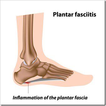 Foot Pain Broomall PA Plantar Fasciitis