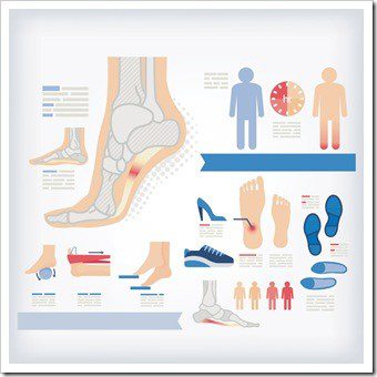 Foot Pain Sunnyvale CA Plantar Fasciitis