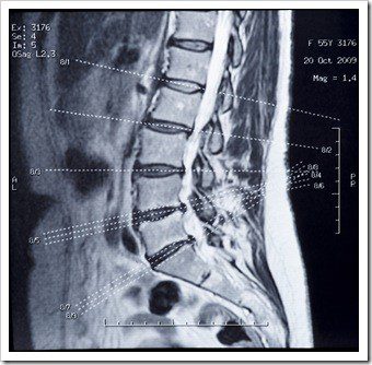 Sciatica Spokane WA