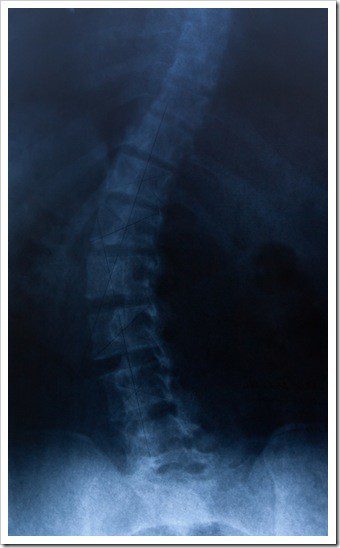 Scoliosis Pottstown