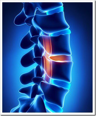 Decompression OFallon IL Low Back Pain