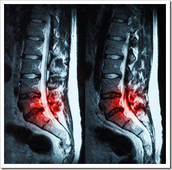 Decompression Berwyn PA Low Back Pain