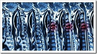 Back Pain Rehab Elverson PA Spinal Surgery